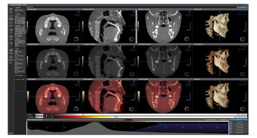 halmadent-OnDemand3D_modul_Fusion Modul Fusion - Software OnDemand3D