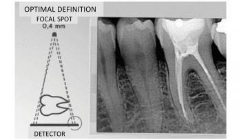 halmadent_RXDC_punct-focal_imagine-optimal-definition Instalatie retroalveolara RXDC - punct focal - imagine otpimal definition